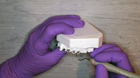 Fixed appliances treatment and bonding in orthodontics