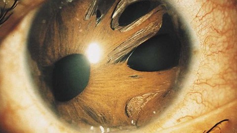 Medical & Surgical Treatment of Glaucoma