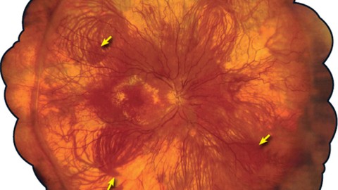 Anatomy & Histology of The Retina, Vitreous, & Choroid