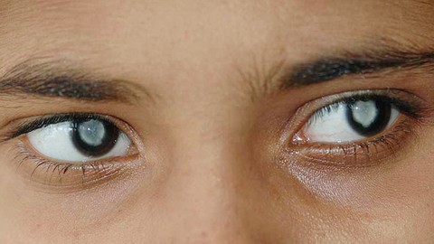 Hypnosis Heal Cataract With Powerful Self Hypnosis